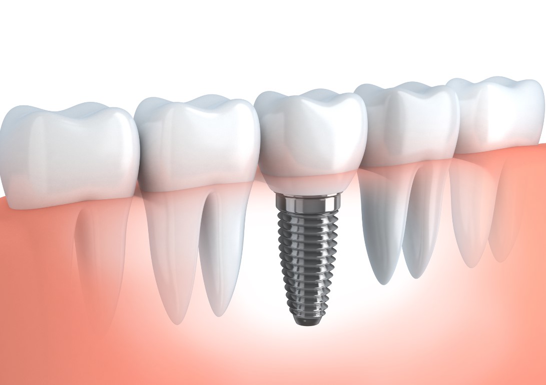 dental-implant-image